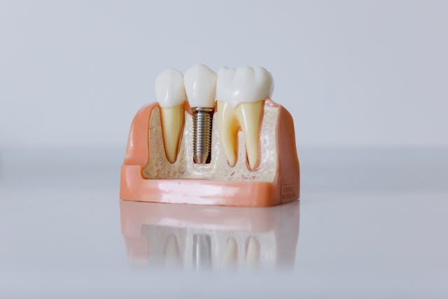 Ból po wszczepieniu implantu zęba – co jest normalne?